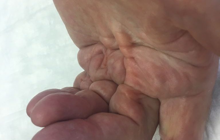 Handchirurgie - Dupuytren Erkrankung